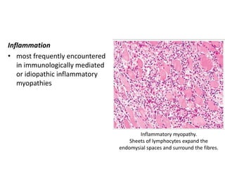 Inflammation
• most frequently encountered
in immunologically mediated
or idiopathic inflammatory
myopathies
Inflammatory myopathy.
Sheets of lymphocytes expand the
endomysial spaces and surround the fibres.
 