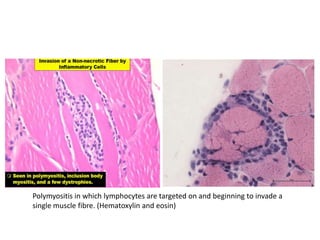 Polymyositis in which lymphocytes are targeted on and beginning to invade a
single muscle fibre. (Hematoxylin and eosin)
 