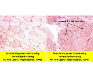 Muscle biopsy section showing
normal lipid staining
Oil Red O(total magnification, ×200).
Muscle biopsy section showing
normal lipid staining
Oil Red O(total magnification, ×200).
 