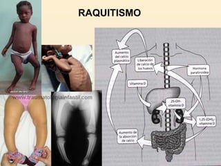 RAQUITISMO
 