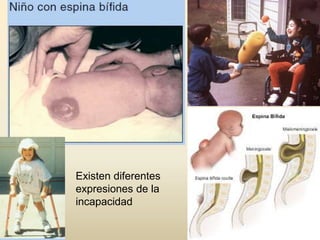 Existen diferentes
expresiones de la
incapacidad
 