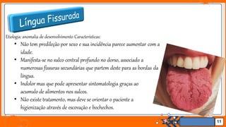 Jens Martensson
Etiologia: anomalia de desenvolvimento Características:
• Não tem predileção por sexo e sua incidência parece aumentar com a
idade.
• Manifesta-se no sulco central profundo no dorso, associado a
numerosas fissuras secundárias que partem deste para as bordas da
língua.
• Indolor mas que pode apresentar sintomatologia graças ao
acumulo de alimentos nos sulcos.
• Não existe tratamento, mas deve se orientar o paciente a
higienização através de escovação e bochechos.
11
 