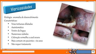 Jens Martensson
Etiologia: anomalia de desenvolvimento
Características:
• Veias tortuosas dilatadas
• Assintomática
• Ventre da língua
• Numerosos nódulos
• Coloração vermelha a azul escura
• Mais comum em pacientes > 60 anos
• Não requer tratamento
15
 