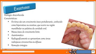 Jens Martensson
Etiologia: desconhecida
Características:
• Os tórus são um crescimento ósseo protuberante, conhecido
como hiperostose ou exostose, que ocorre na região
mandibular ou palatina da cavidade oral.
• Massa óssea de crescimento lento
• Assintomático
• Radiograficamente se apresentam como áreas
radiopacas circunscritasou difusas
• Remoção cirúrgica
17
 