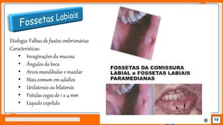 Jens Martensson
Etiologia: Falhas de fusões embrionárias
Características:
• Invaginações da mucosa
• Ângulos da boca
• Arcos mandibular e maxilar
• Mais comum em adultos
• Unilaterais ou bilaterais
• Fístulas cegas de 1 a 4 mm
• Líquido expelido
19
 