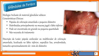 Jens Martensson
Etiologia: Inclusão de material glandular sebáceo
Características Clínicas:
• Pápulas de coloração amarelada e pequeno diâmetro
• Distribuídas principalmente na mucosa jugal e lábio inferior
• Pode ser encontrada em grande ou pequena quantidade
• Não necessita de tratamento
Descrição da Lesão: pápula unilocular ou multilocular de coloração
amarelada, localizada no lábio inferior, superfície lisa, arredondada,
tamanho aproximadamente de 1 mm de diâmetro
3
 