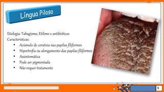 Jens Martensson
Etiologia: Tabagismo, Etilimo e antibióticos
Características:
• Acúmulo de ceratina nas papilas filiformes
• Hipertrofia ou alongamento das papilas filiformes
• Assintomática
• Pode ser pigmentada
• Não requer tratamento
6
 