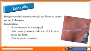 Jens Martensson
Etiologia: Associada à pressão, irritação por fricção, ou trauma
por sucção da mucosa.
Características:
• Alteração comum da mucosa jugal.
• Linha branca geralmente bilateral ao nível do plano
oclusal dos dentes.
• Não é necessário tratamento.
8
 