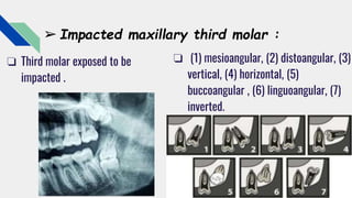 Variation of upper permanent molars | PPTX