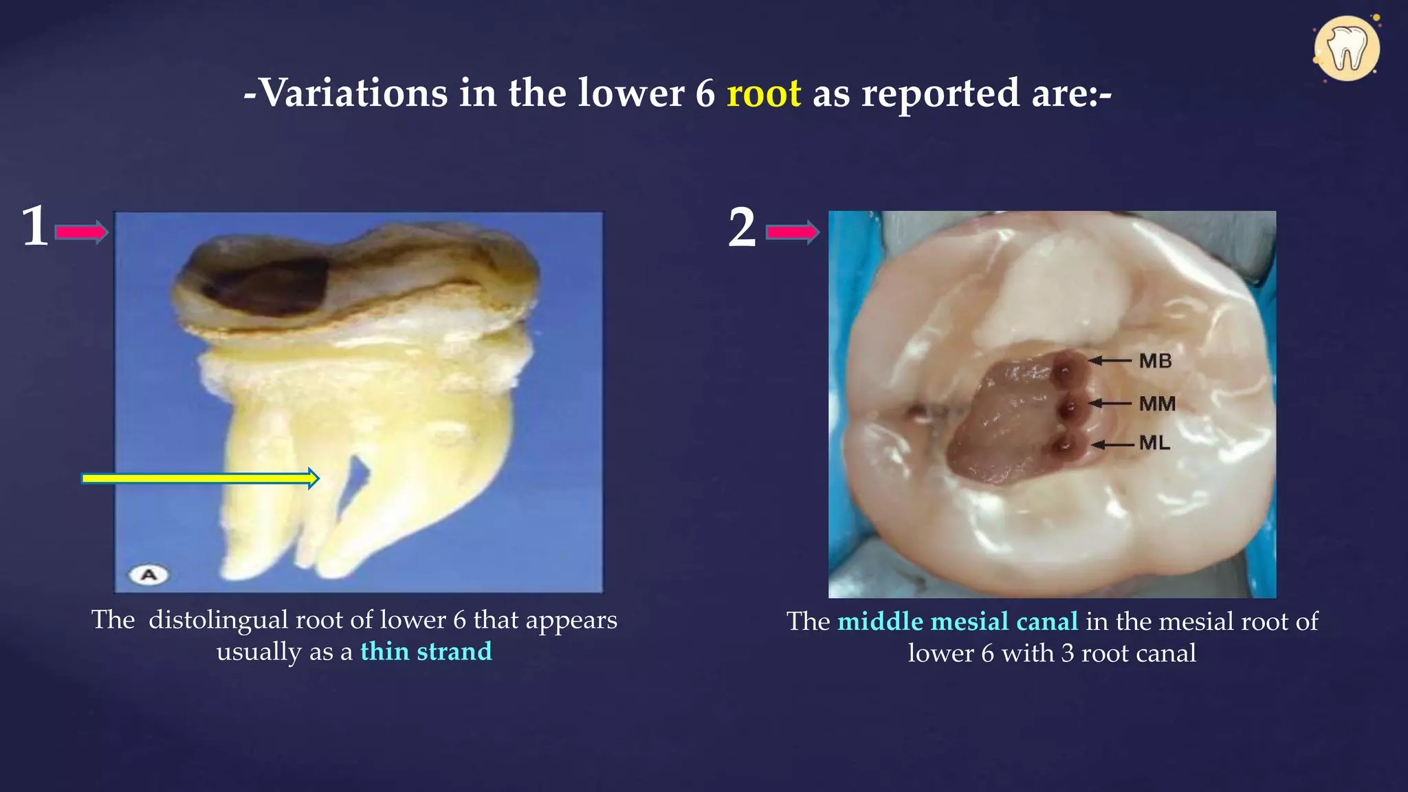 -Variations in the lower 6 root as reported are:-
The distolingual root of lower 6 that appears
usually as a thin strand
The middle mesial canal in the mesial root of
lower 6 with 3 root canal
1 2
 