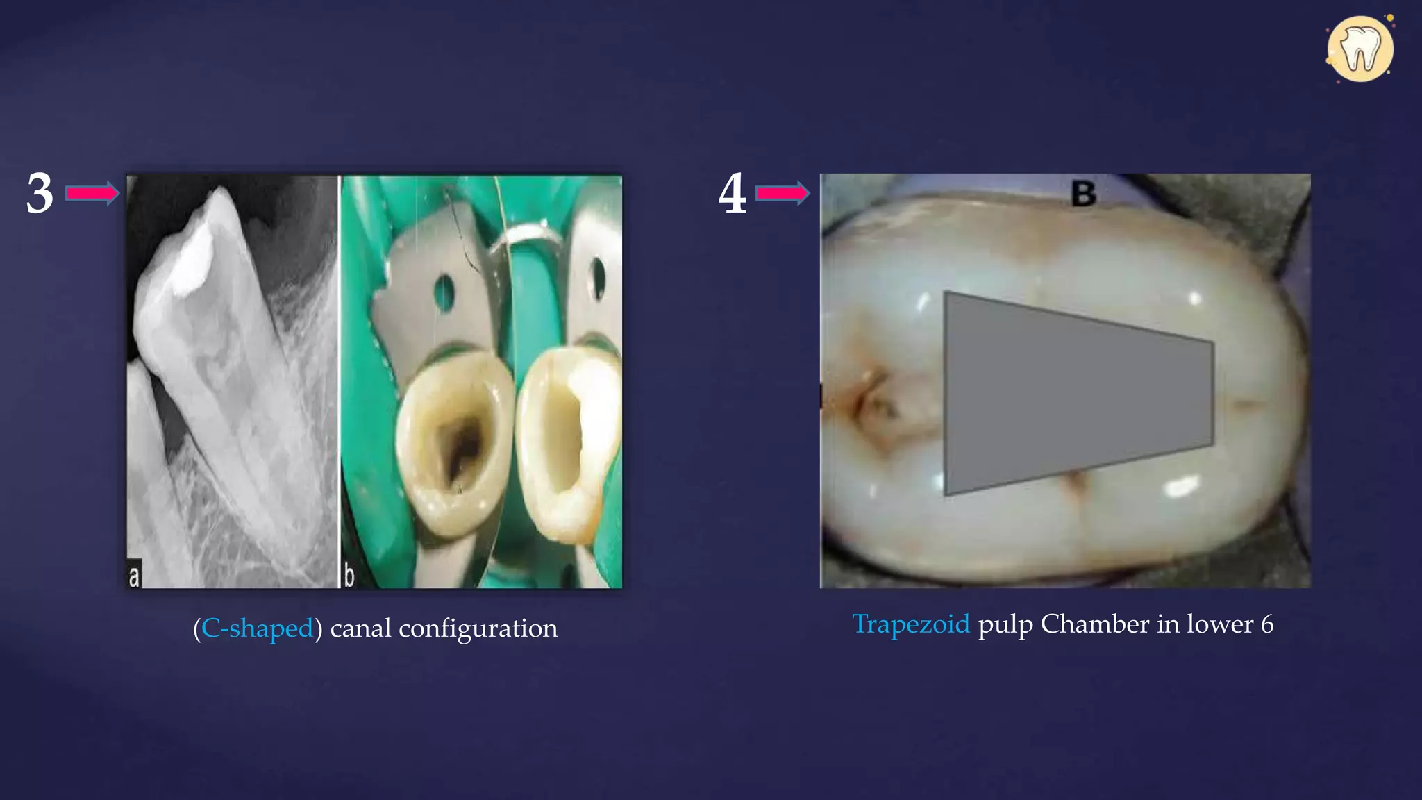 3
(C-shaped) canal configuration Trapezoid pulp Chamber in lower 6
4
 