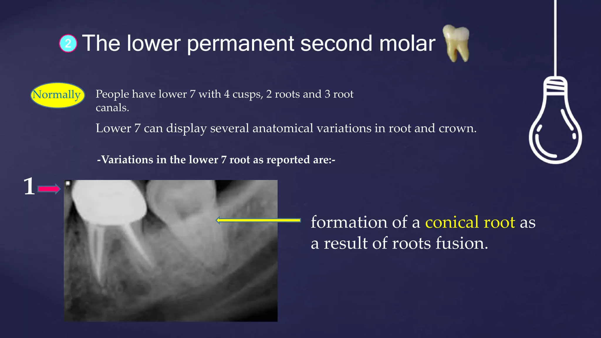 2 The lower permanent second molar
Lower 7 can display several anatomical variations in root and crown.
Normally People have lower 7 with 4 cusps, 2 roots and 3 root
canals.
-Variations in the lower 7 root as reported are:-
formation of a conical root as
a result of roots fusion.
1
 