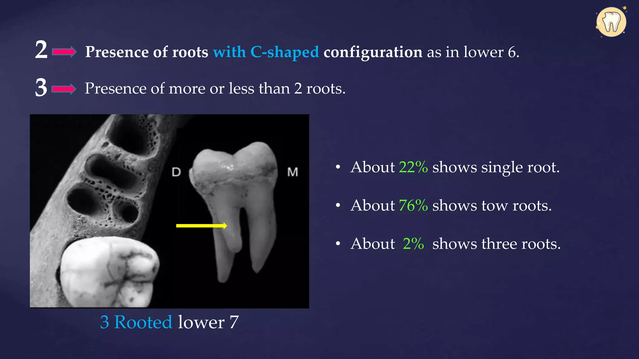 2 Presence of roots with C-shaped configuration as in lower 6.
Presence of more or less than 2 roots.3
3 Rooted lower 7
• About 22% shows single root.
• About 76% shows tow roots.
• About 2% shows three roots.
 
