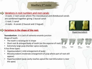 Variations in root numbers and root canals:
-3 roots: 2 root canals where The mesiobuccal and distobuccal canals
are combined together giving 1 buccal canal
-1 root: 1 canal
-4 roots : 4 canals (2 buccal and 2 lingual)
Variations in the shape of the root:
Taurodontism : It is Lack of cemento-enamle junction
Shape of tooth:
• The tooth is rectangular in shape
• Short root & enlarged body of tooth (on the expense of root)
• Extremely large pulp chamber apico-occlusaly
It has three types:
• Hypotaurodont ( mild enlargement of pulp)
• Mesotaurodont (moderate enlargement of pulp where part of root still
appear)
• Hypertaurodont (pulp cavity reaches apical the root bifurcation is near
the apex)
Normal
(cynodont)
hypo Meso
taurodont
hyper
Maxillary 2nd molar
Hypertaurodont
 