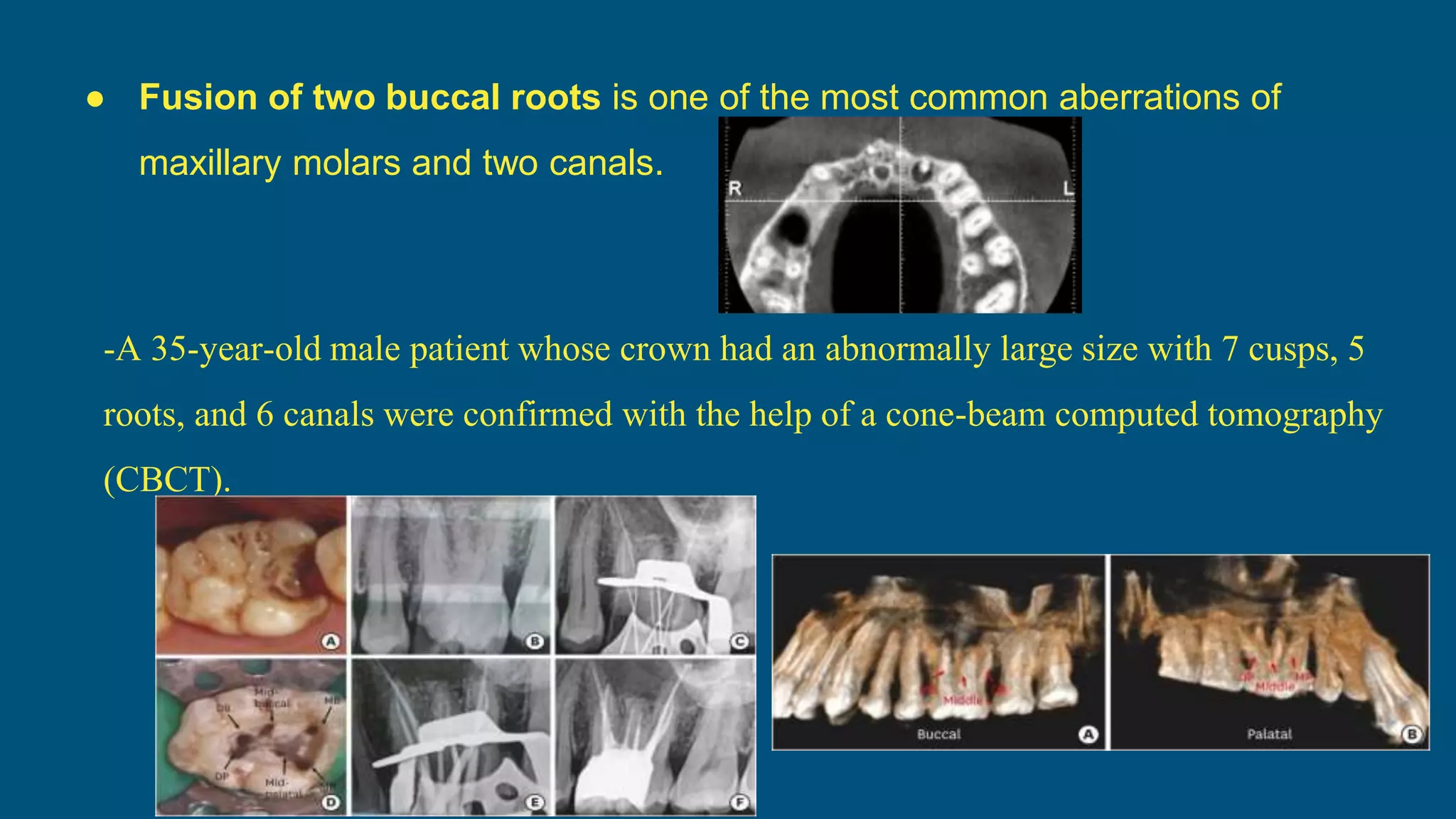 -A 35-year-old male patient whose crown had an abnormally large size with 7 cusps, 5
roots, and 6 canals were confirmed with the help of a cone-beam computed tomography
(CBCT).
● Fusion of two buccal roots is one of the most common aberrations of
maxillary molars and two canals.
 