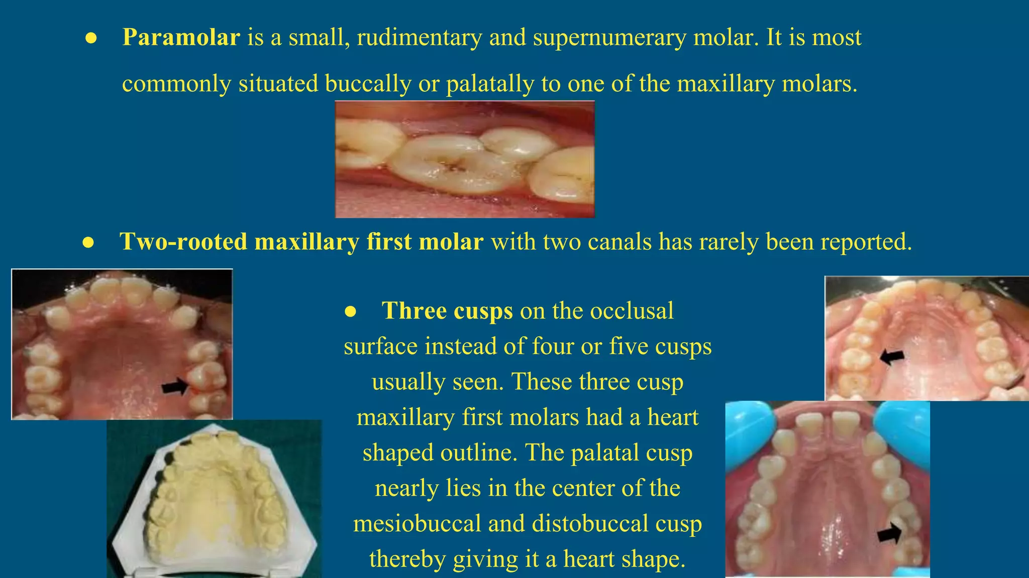 ● Three cusps on the occlusal
surface instead of four or five cusps
usually seen. These three cusp
maxillary first molars had a heart
shaped outline. The palatal cusp
nearly lies in the center of the
mesiobuccal and distobuccal cusp
thereby giving it a heart shape.
● Paramolar is a small, rudimentary and supernumerary molar. It is most
commonly situated buccally or palatally to one of the maxillary molars.
● Two-rooted maxillary first molar with two canals has rarely been reported.
 