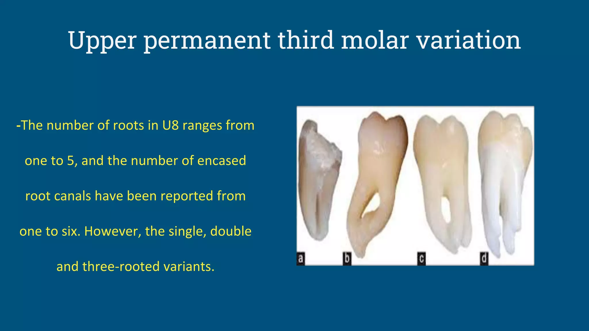 -The number of roots in U8 ranges from
one to 5, and the number of encased
root canals have been reported from
one to six. However, the single, double
and three-rooted variants.
Upper permanent third molar variation
 