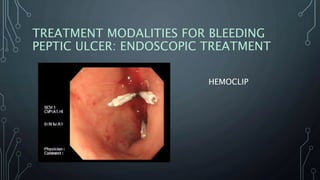TREATMENT MODALITIES FOR BLEEDING
PEPTIC ULCER: ENDOSCOPIC TREATMENT
HEMOCLIP
 