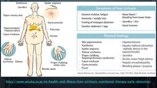 https://www.otsuka.co.jp/en/health-and-illness/liver-cirrhosis-nutritional-therapy/early-detection/
 