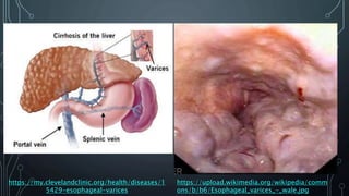 F
https://my.clevelandclinic.org/health/diseases/1
5429-esophageal-varices
https://upload.wikimedia.org/wikipedia/comm
ons/b/b6/Esophageal_varices_-_wale.jpg
 