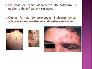  Em caso de febre decorrente da catapora, o 
paciente deve ficar em repouso. 
 Outras formas de prevenção incluem: evitar 
aglomerações, manter os ambientes ventilados . 
 