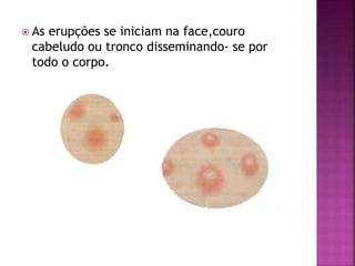 As erupções se iniciam na face,couro 
cabeludo ou tronco disseminando- se por 
todo o corpo. 
 