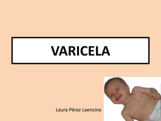 VARICELA
Laura Pérez Laencina
 