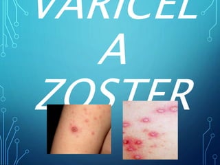 VARICEL
A
ZOSTER
 