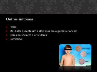 Outros sintomas:
 Febre;
 Mal-Estar durante um a dois dias em algumas crianças;
 Dores musculares e articulares;
 Comichão;
 