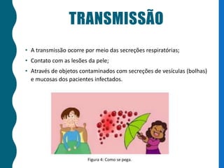 TRANSMISSÃO
• A transmissão ocorre por meio das secreções respiratórias;
• Contato com as lesões da pele;
• Através de objetos contaminados com secreções de vesículas (bolhas)
e mucosas dos pacientes infectados.
 
