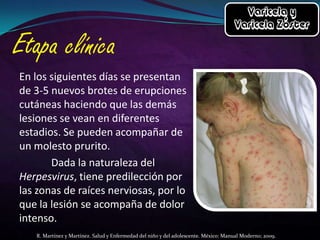 En los siguientes días se presentan
de 3-5 nuevos brotes de erupciones
cutáneas haciendo que las demás
lesiones se vean en diferentes
estadios. Se pueden acompañar de
un molesto prurito.
Dada la naturaleza del
Herpesvirus, tiene predilección por
las zonas de raíces nerviosas, por lo
que la lesión se acompaña de dolor
intenso.
R. Martínez y Martínez. Salud y Enfermedad del niño y del adolescente. México: Manual Moderno; 2009.

 