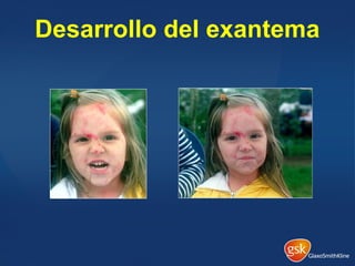 Desarrollo del exantema
 