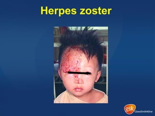 Herpes zoster
 
