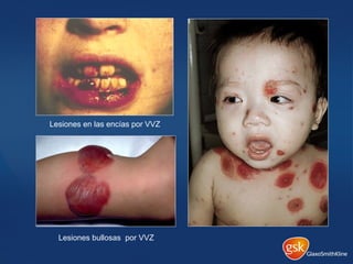 Lesiones en las encías por VVZ
Lesiones bullosas por VVZ
 