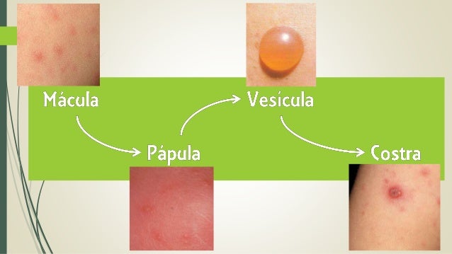 Varicela 2015