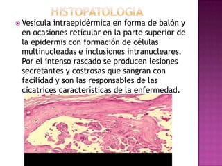 histopatologiaVesícula intraepidérmica en forma de balón y en ocasiones reticular en la parte superior de la epidermis con formación de células multinucleadas e inclusiones intranucleares.Por el intenso rascado se producen lesiones secretantes y costrosas que sangran con facilidad y son las responsables de las cicatrices características de la enfermedad.