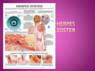 Herpes zoster