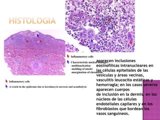 histologiaapareceninclusioneseosinofílicas intranucleares en las células epiteliales de las vesículas y áreas vecinas,vasculitis leucocito estáticas y hemorragia; en los casos severos aparecen cuerposde inclusión en la dermis, en los núcleos de las células endoteliales capilares y en losfibroblastos que bordean los vasos sanguíneos.