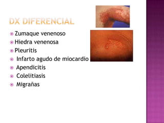 DxdiferencialZumaque venenoso Hiedra venenosaPleuritis Infarto agudo de miocardio Apendicitis Colelitiasis Migrañas