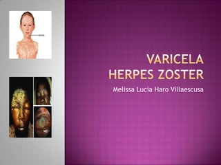 Varicelaherpes zoster,[object Object],Melissa Lucia HaroVillaescusa,[object Object]