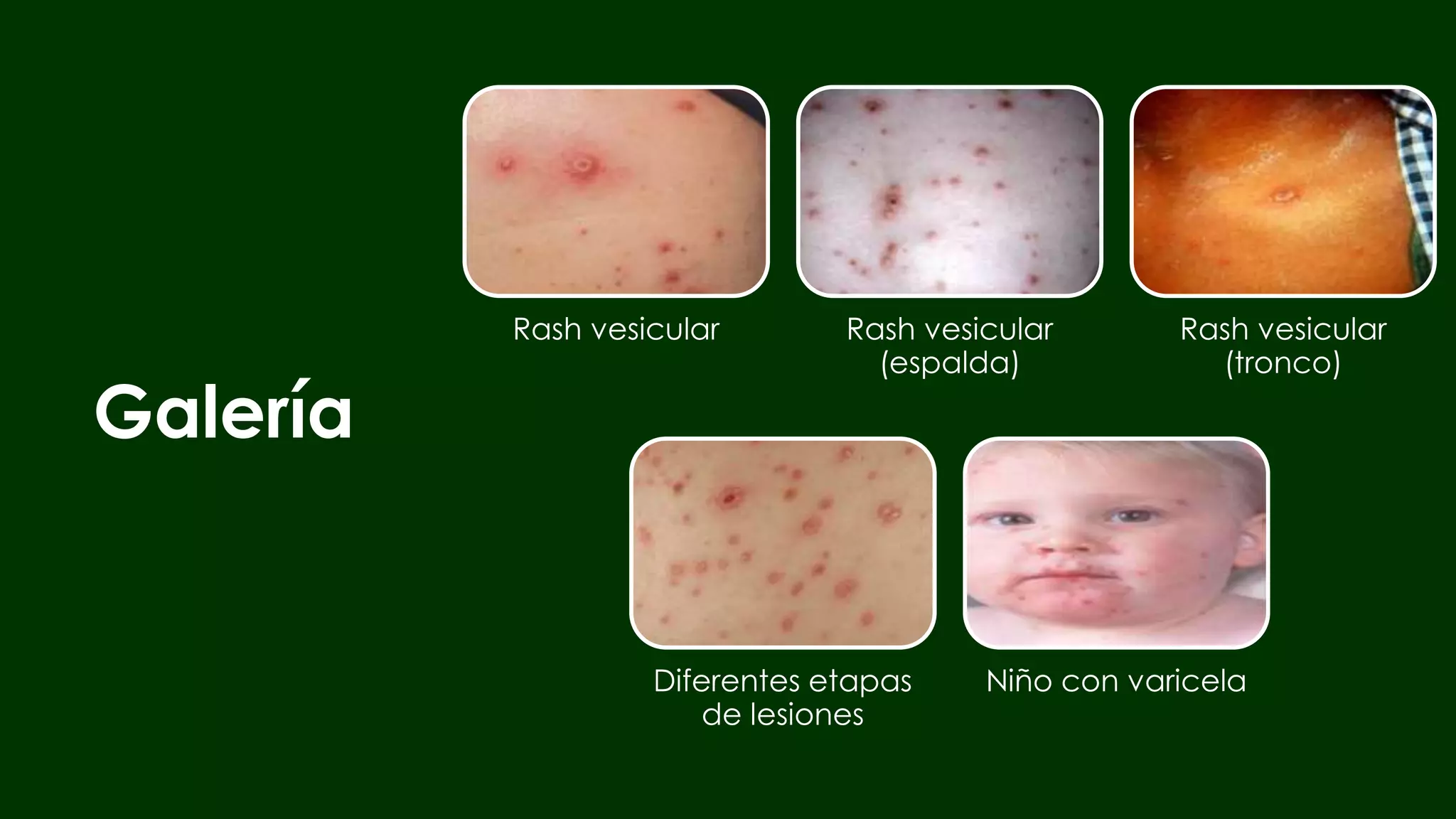 Varicela y sarampión PPT