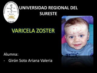 VARICELA ZOSTER
Alumna:
- Girón Soto Ariana Valeria
UNIVERSIDAD REGIONAL DEL
SURESTE
 