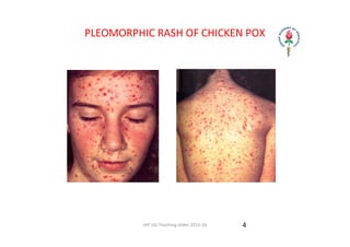 Comprehensive Overview of Varicella (Chicken Pox) and Herpes Zoster | PDF