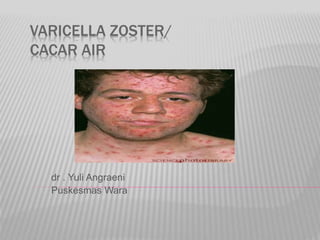 VARICELLA ZOSTER/
CACAR AIR
dr . Yuli Angraeni
Puskesmas Wara
 