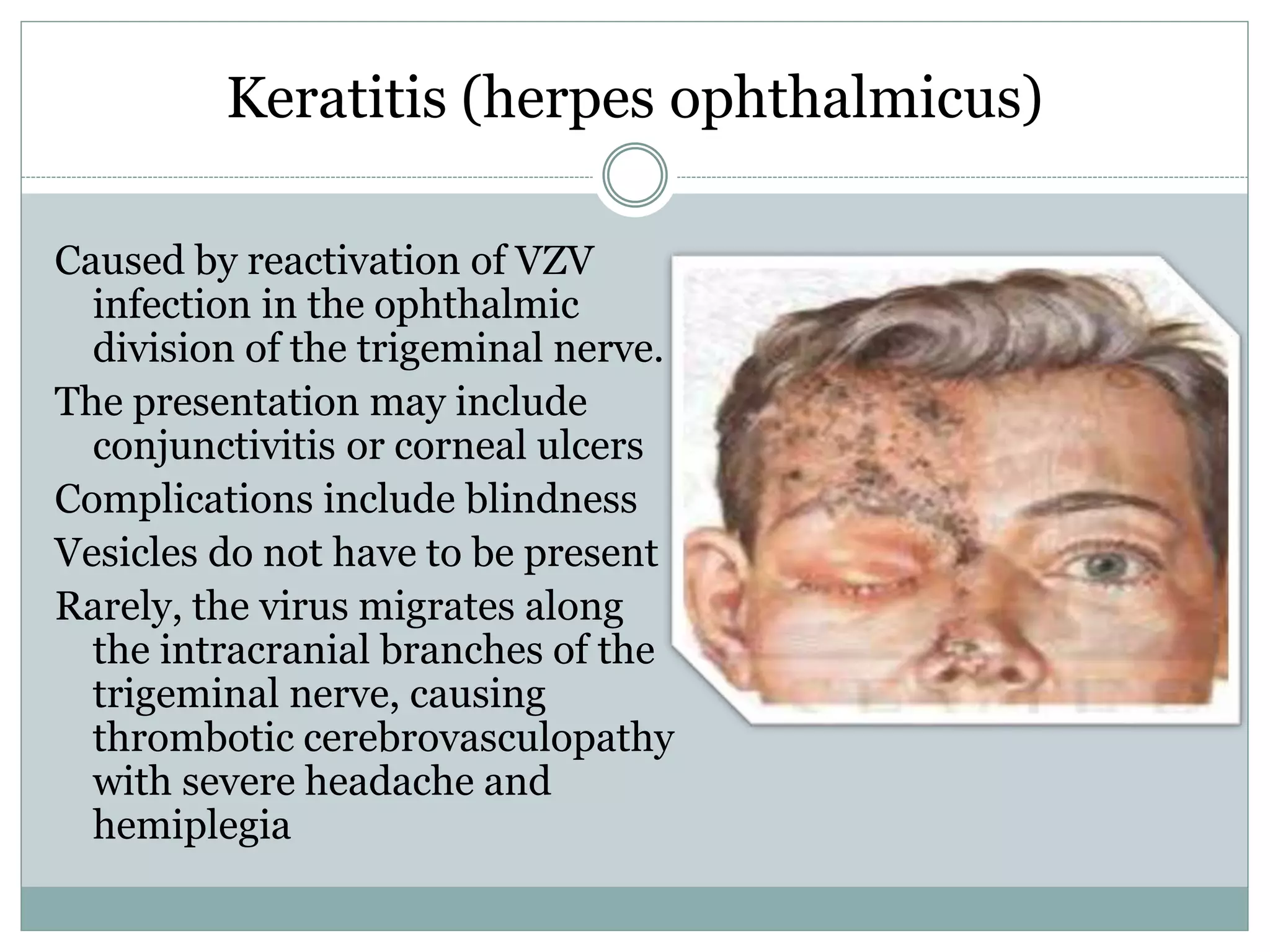 Varicella Zoster Virus Infections PPTX