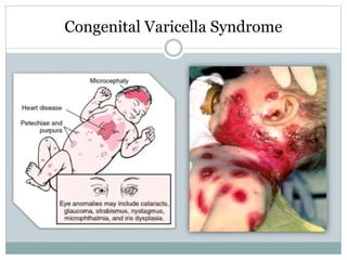 Varicella Zoster Virus Infections