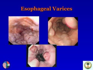 Esophageal Varices 