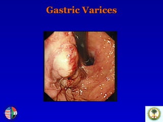 Gastric Varices 
