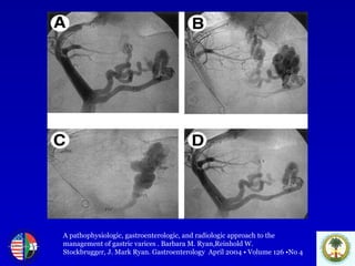 A pathophysiologic, gastroenterologic, and radiologic approach to the  management of gastric varices . Barbara M. Ryan,Reinhold W.  Stockbrugger, J. Mark Ryan. Gastroenterology  April 2004 • Volume 126 •No 4 