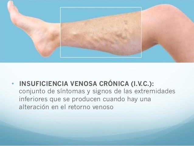 Todo sobre varikoze de las venas interiores de las extremidades inferiores